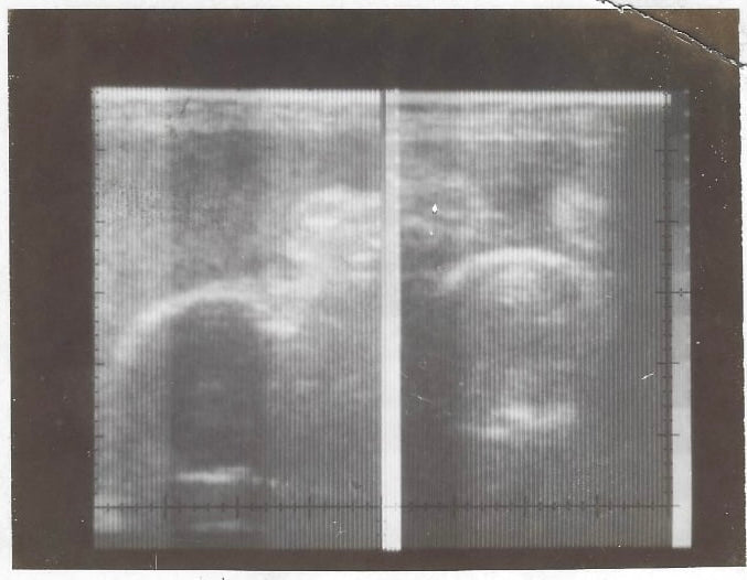twin ultrasound