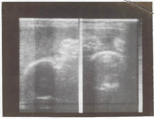 twin ultrasound